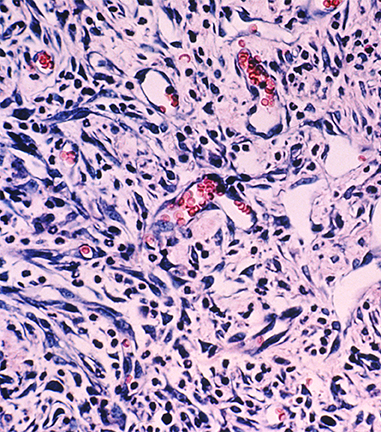 kaposi sarcoma